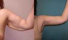 Брахиопластика (пластика рук)