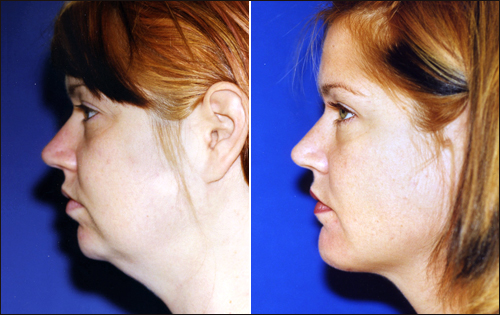 пластика подбородка