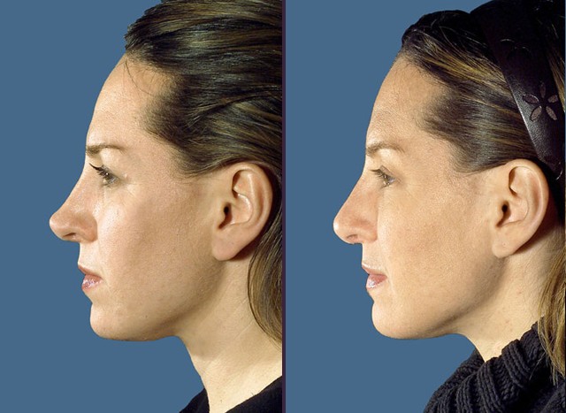 ринопластика